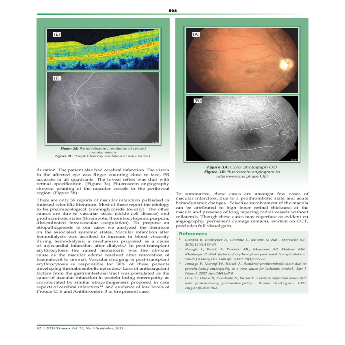 vein occlusion and diabetic retinopathy