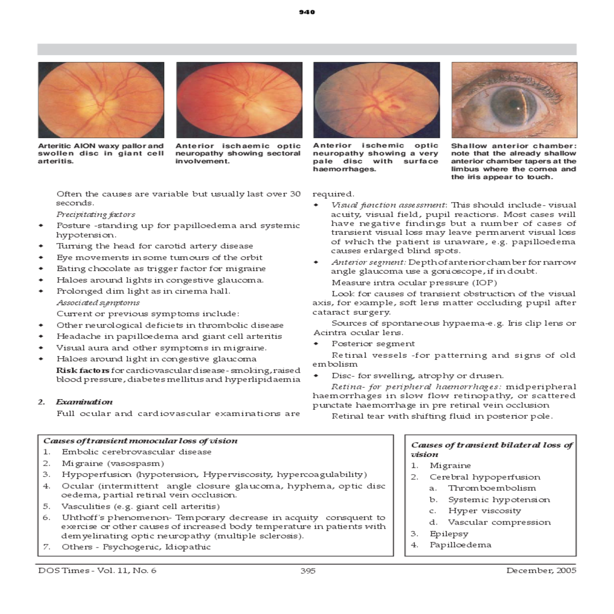 ocular intermittent angle closure glaucoma