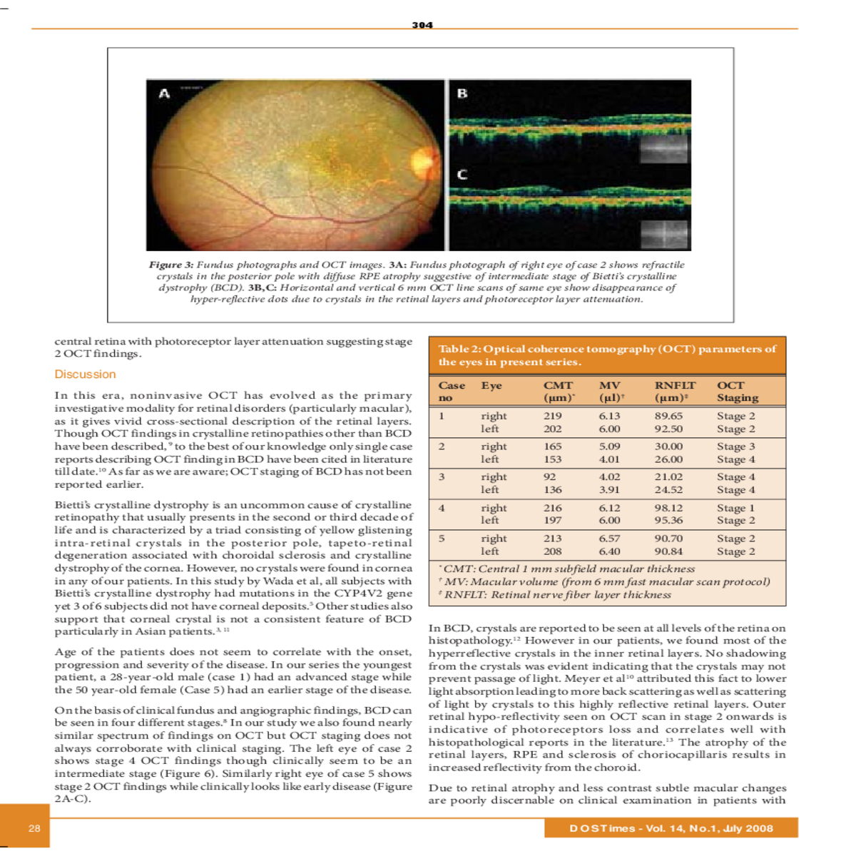 macular thickness map shows global retinal thinnin
