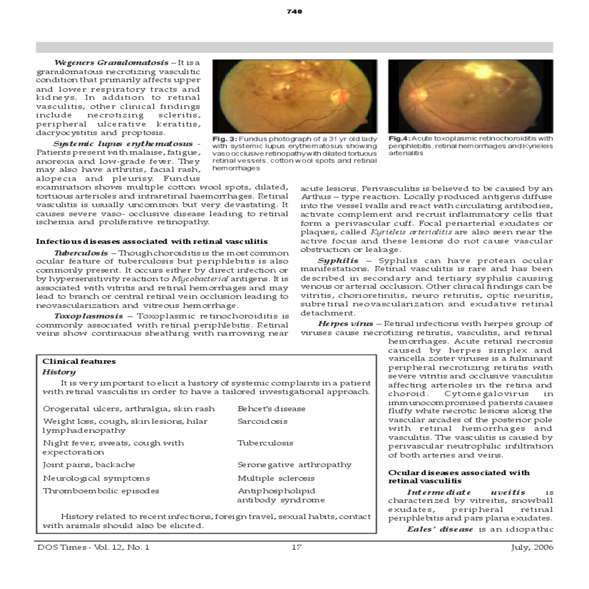 retinal vasculitis and cystoid macular odema vitre