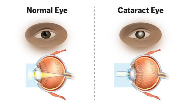 Cataract And Refractive Surgery img1