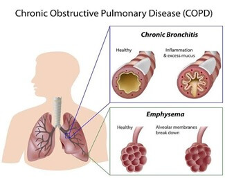 COPD img1