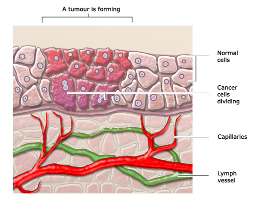 Carcinoma cancer cells