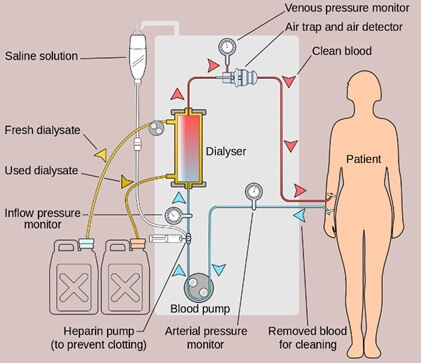 Hemodialysis