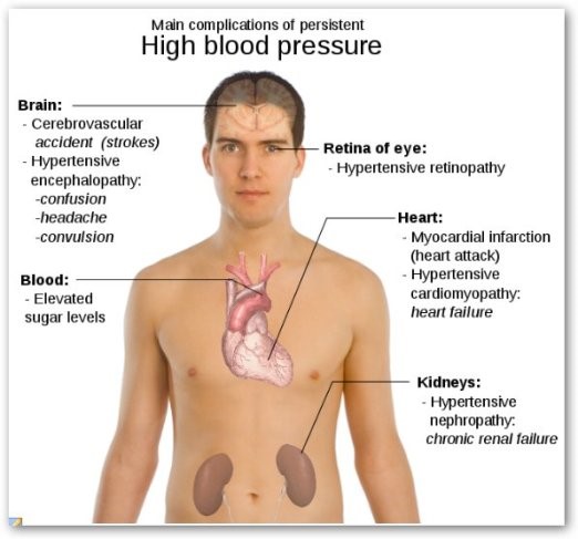 High Blood Pressure High Blood Pressure