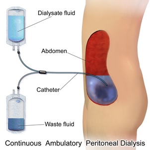 peritoneal dialysis