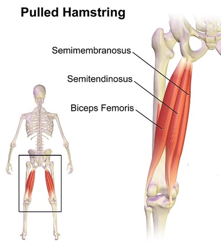 pulled hamstring
